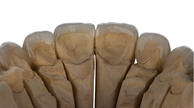 How to Bond Porcelain Veneers